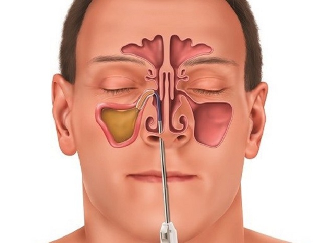 Cảnh giác việc tự điều trị viêm xoang