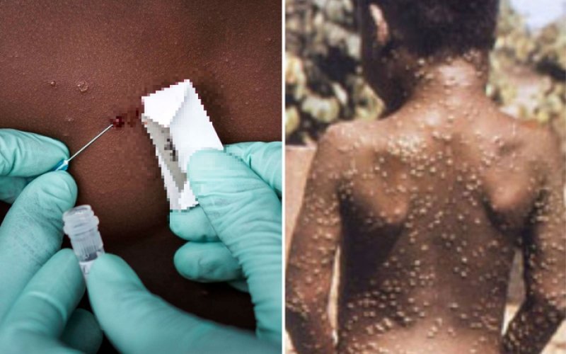 Cần biết: Bộ Y tế khuyến cáo 6 biện pháp phòng chống bệnh đậu mùa khỉ đang 'nóng' tại nhiều quốc gia