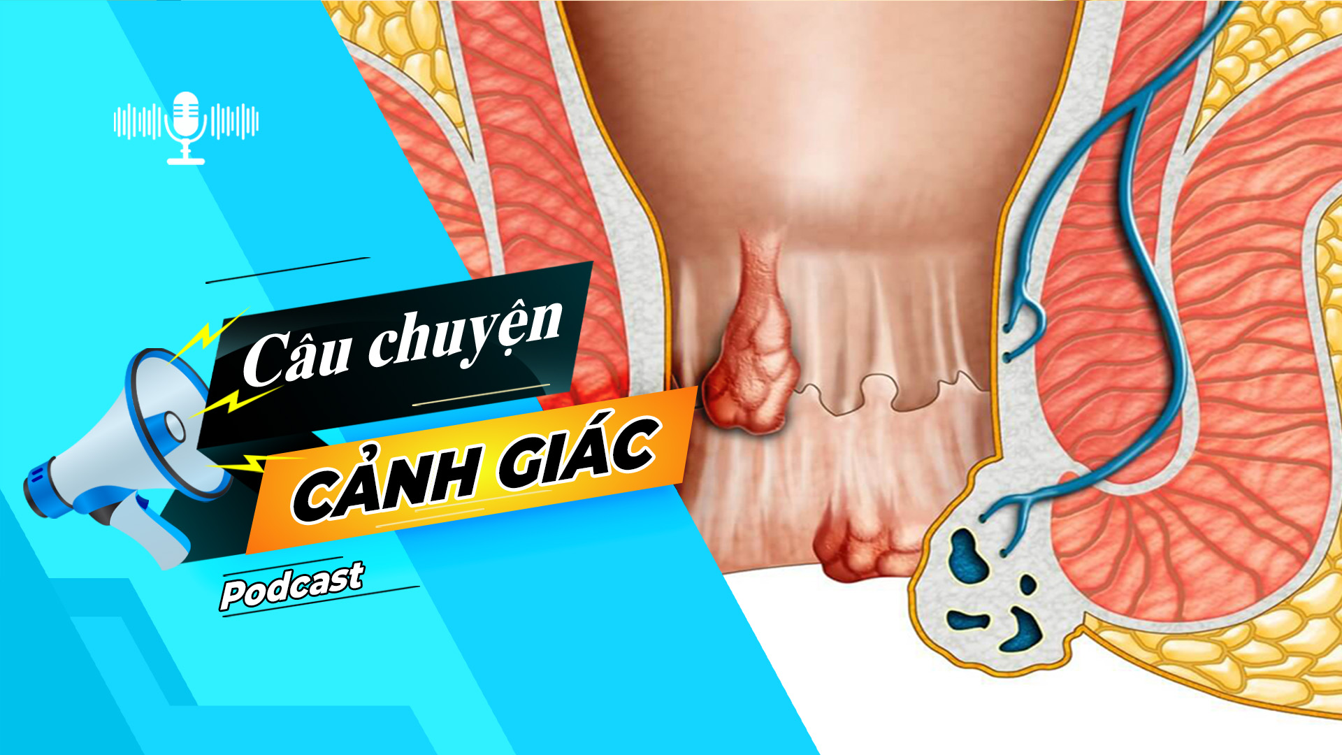 Cẩn trọng với biến chứng của trĩ nội | Câu chuyện cảnh giác