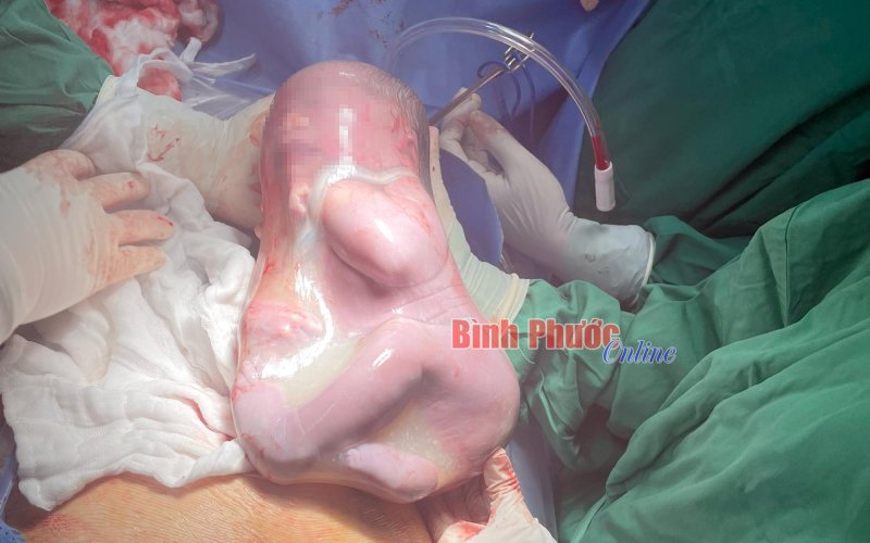 Bình Phước: Thú vị bé gái chào đời trong ‘bọc điều’