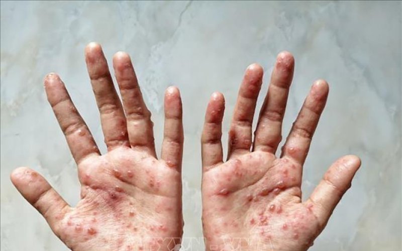 Nga xác nhận trường hợp mắc bệnh đậu mùa khỉ đầu tiên