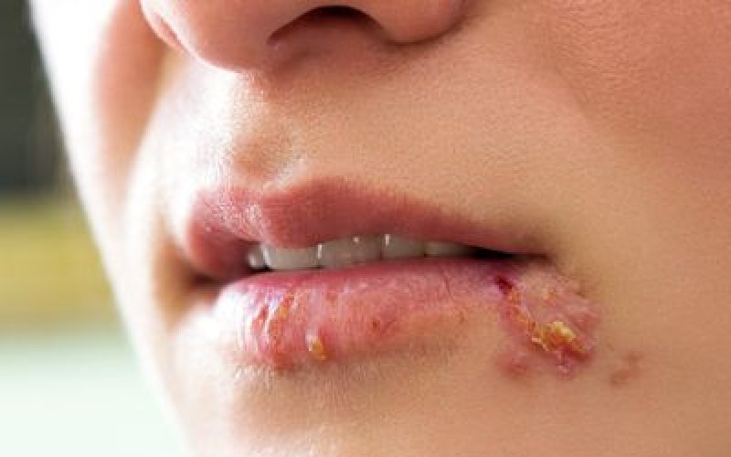 Nghi&ecirc;n cứu về nguồn gốc căn bệnh vi&ecirc;m da phổ biến do nhiễm virus herpes