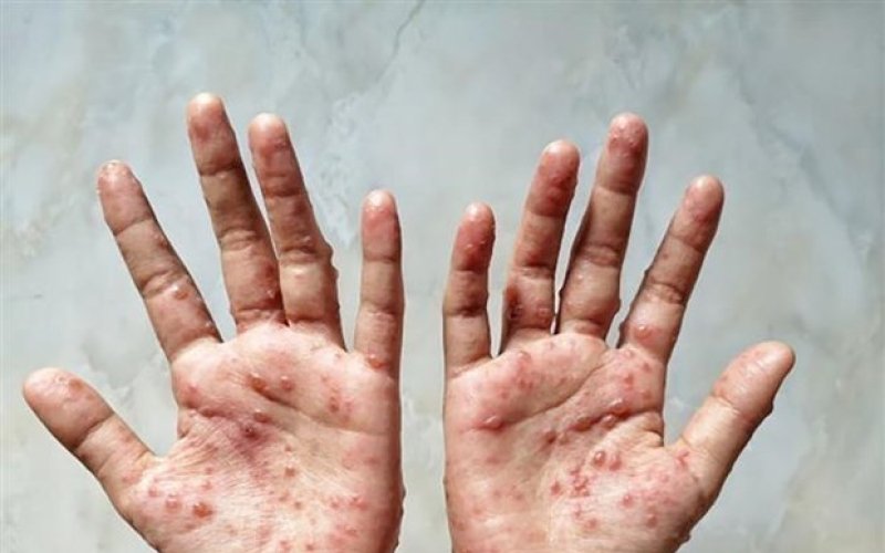 WHO ban bố tình trạng khẩn cấp y tế toàn cầu đối với bệnh đậu mùa khỉ