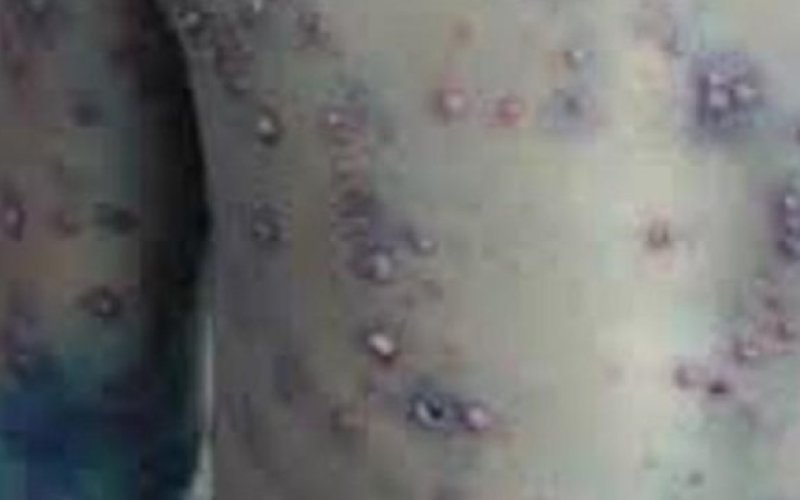 Chuyên gia khuyến cáo người dân nên tiêm vaccine, không chủ quan với bệnh thủy đậu