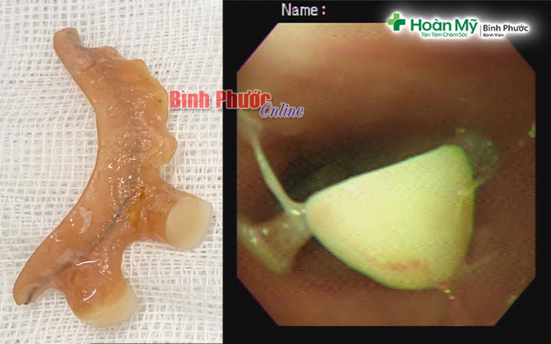 Cấp cứu th&agrave;nh c&ocirc;ng bệnh nh&acirc;n nuốt phải răng giả khi đang ăn