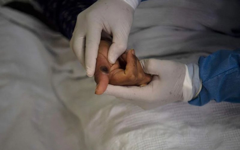 Virus đậu m&ugrave;a khỉ c&oacute; thể b&aacute;m l&acirc;u tr&ecirc;n c&aacute;c vật dụng gia đ&igrave;nh