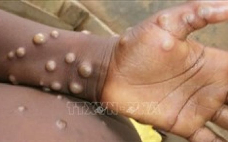 WHO khuyến c&aacute;o: Bất cứ ai cũng c&oacute; thể mắc bệnh đậu m&ugrave;a khỉ