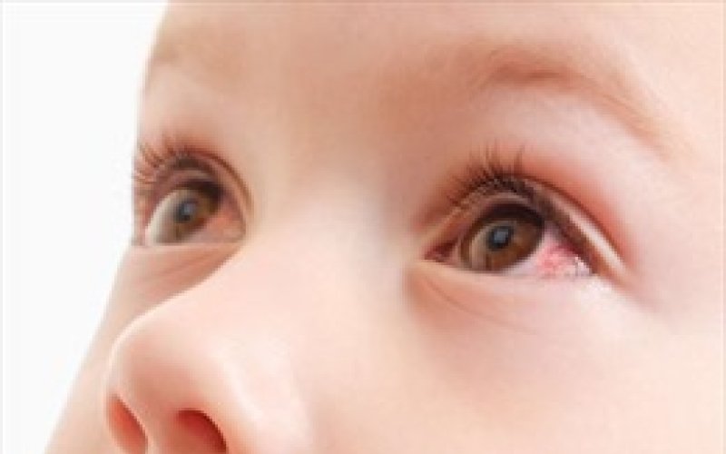Đau mắt đỏ biến chứng có thể ảnh hưởng tới thị lực lâu dài của trẻ