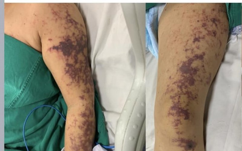 Một phụ nữ mắc liên cầu lợn tình trạng nguy kịch sau khi ăn lòng