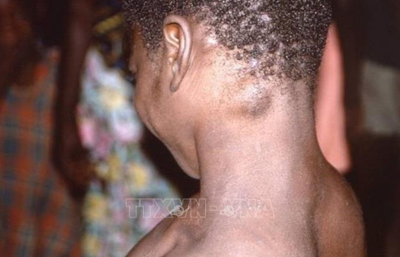 WHO triệu tập cuộc họp khẩn về sự lây lan của bệnh đậu mùa khỉ