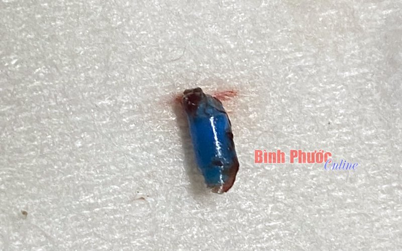 Bình Phước: Bé 4 tuổi bị bạn học vô tình nhét đồ chơi vào tai