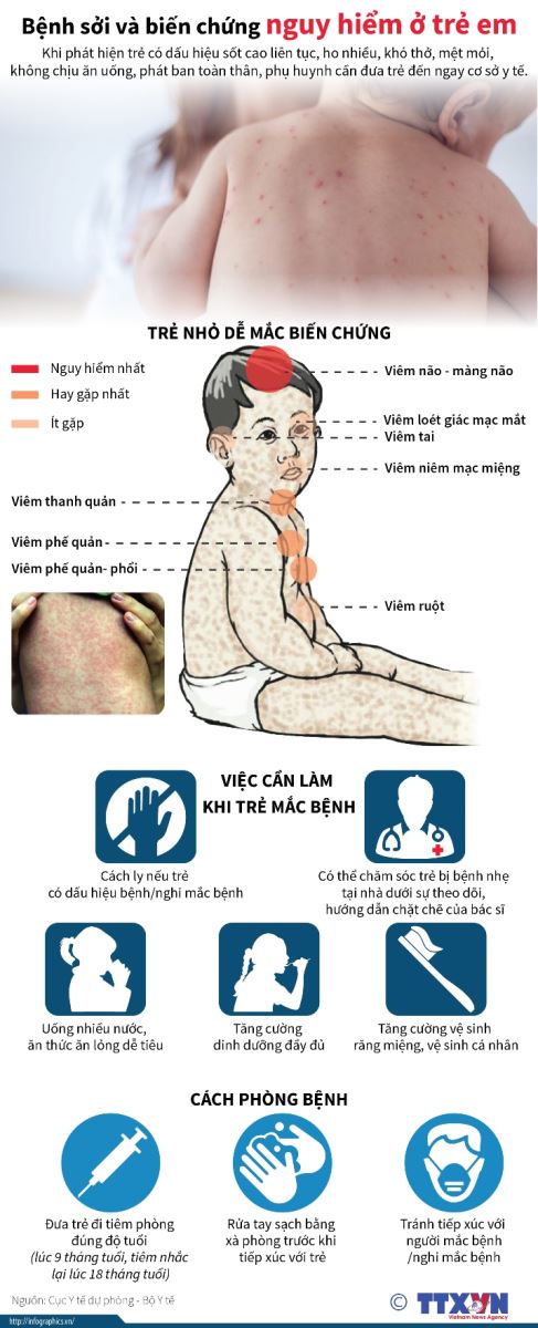 Số ca sốt phát ban nghi sởi tăng 2,7 lần so với cùng kỳ năm 2023