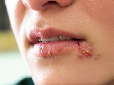 6. Phòng Ngừa Bệnh Herpes