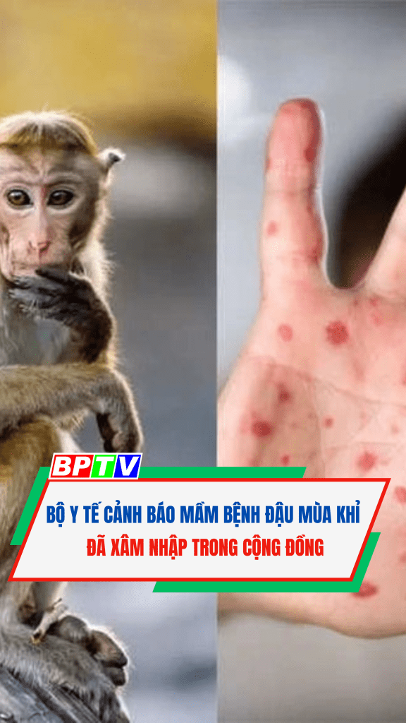 Bộ Y tế cảnh báo mầm bệnh đậu mùa khỉ đã xâm nhập trong cộng đồng #short