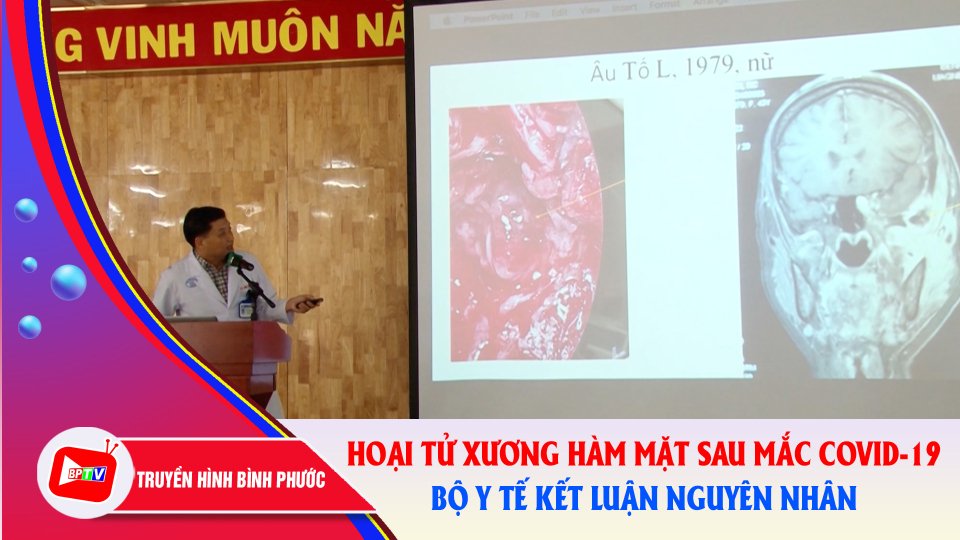 Đã có kết luận về các bệnh nhân bị hoại tử xương hàm mặt hậu Covid-19 |BPTV