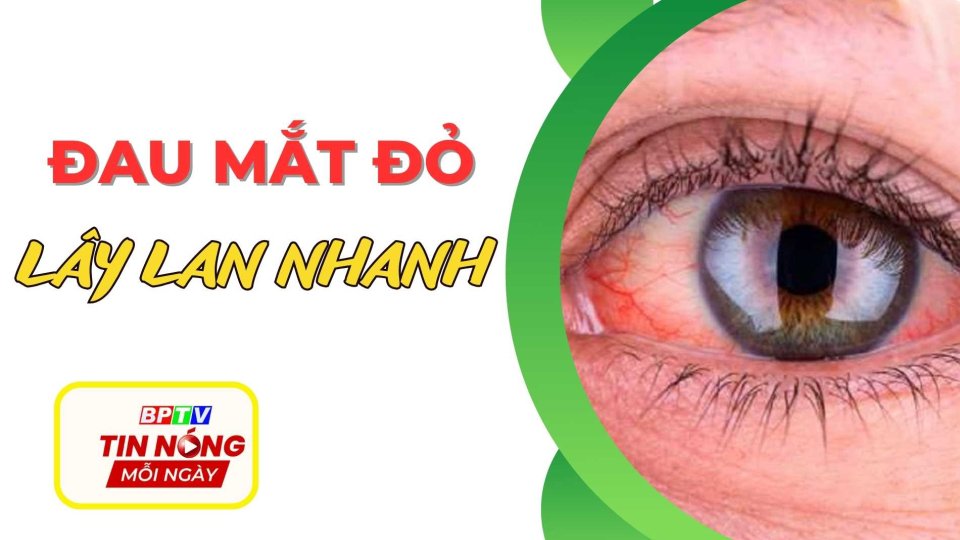 Đau mắt đỏ gia tăng, Bộ Y tế ra 5 khuyến cáo |BPTV hot news