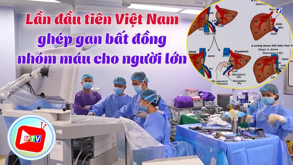 Lần đầu tiên Việt Nam ghép gan bất đồng nhóm máu cho người lớn |BPTV