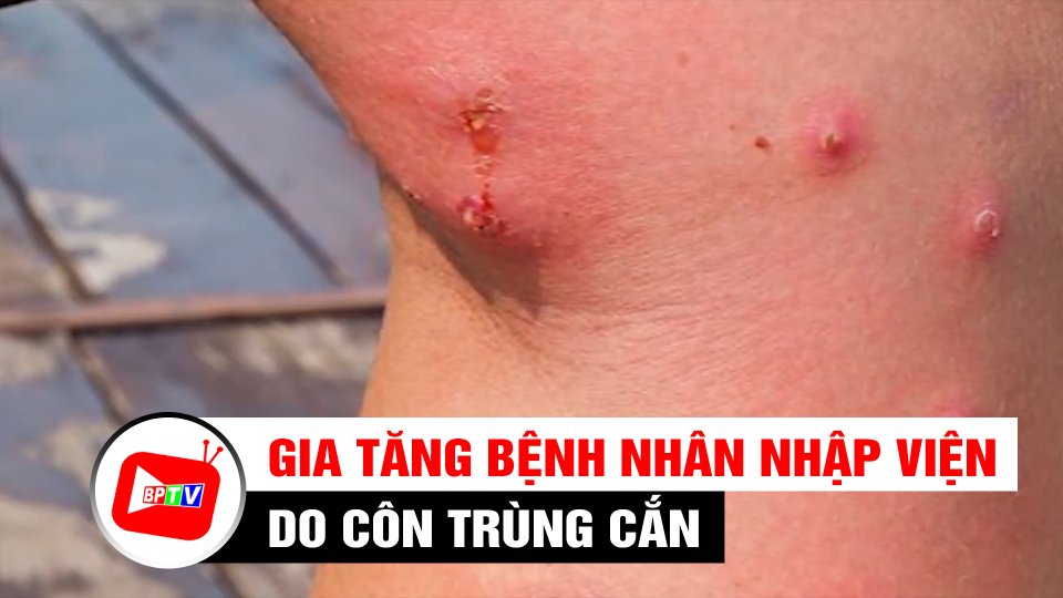 Nắng mưa thất thường, gia tăng bệnh nhân nhập viện do côn trùng cắn | BPTV