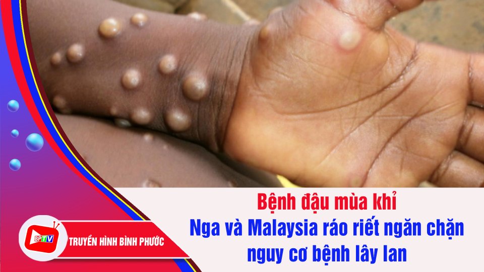 Nga và Malaysia xác nhận các trường hợp mắc bệnh đậu mùa khỉ đầu tiên | BPTV
