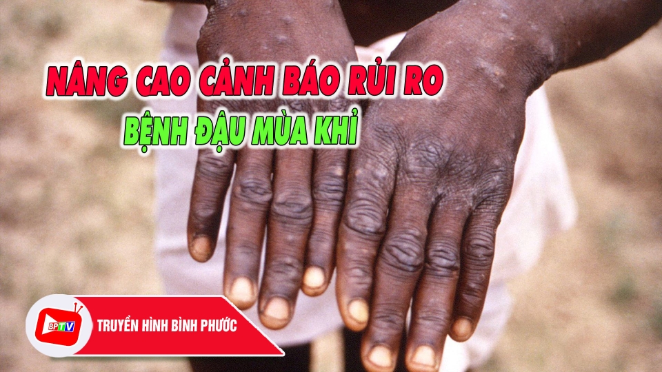Nhiều nước nâng cao cảnh báo rủi ro với bệnh đậu mùa khỉ |BPTV