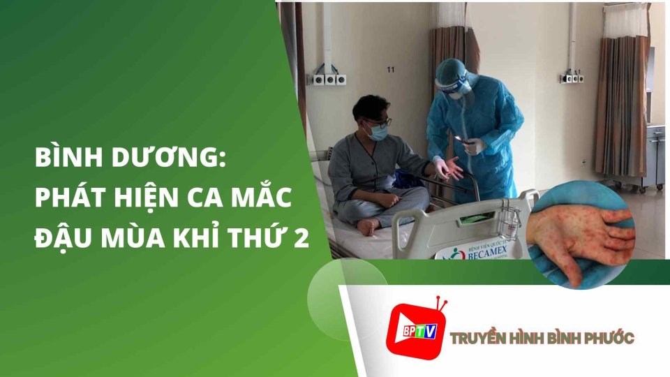 NÓNG: Bình Dương phát hiện ca mắc đậu mùa khỉ thứ 2