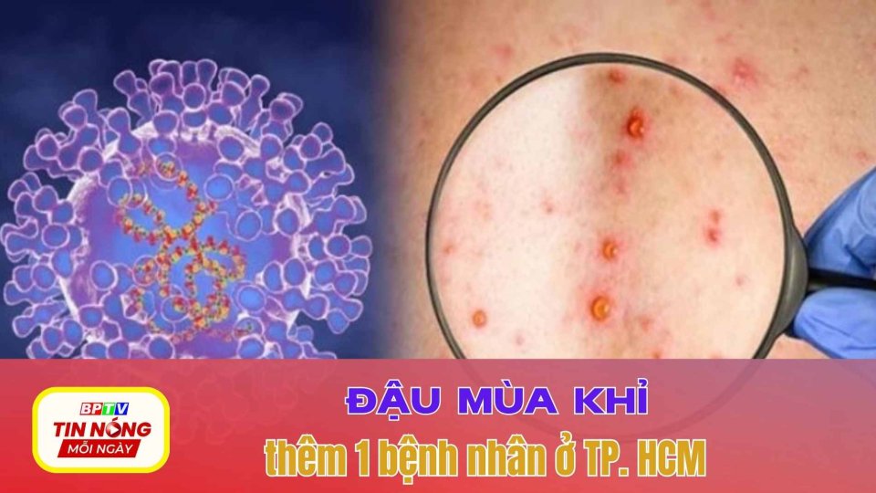 Nóng: Phát hiện thêm 1 trường hợp mắc đậu mùa khỉ ở TP.HCM