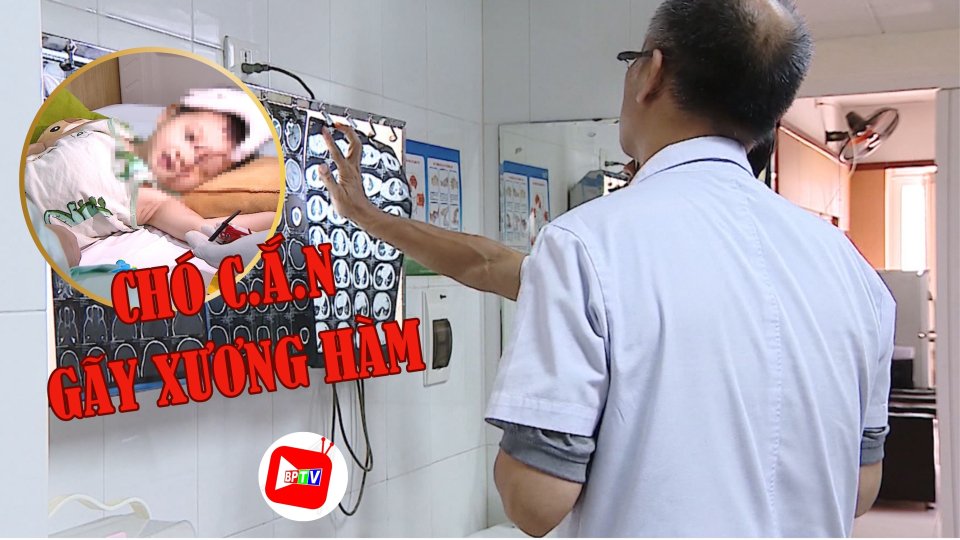 Quá nguy hiểm: Bé trai 3 tuổi bị chó c.ắ.n gãy xương hàm