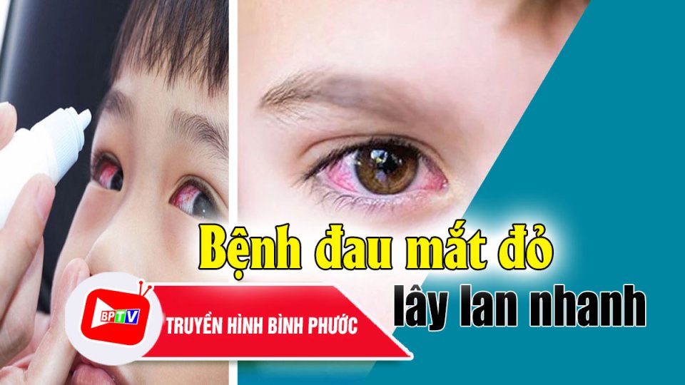 TP. Đồng Xoài, Bình Phước: Bệnh đau mắt đỏ lây lan nhanh ở nhiều trường học |BPTV