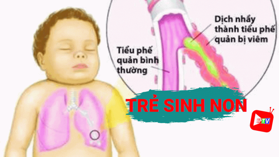 Trẻ sinh non sẽ rất dễ mắc bệnh viêm phổi - Làm sao để theo dõi và điều trị? 