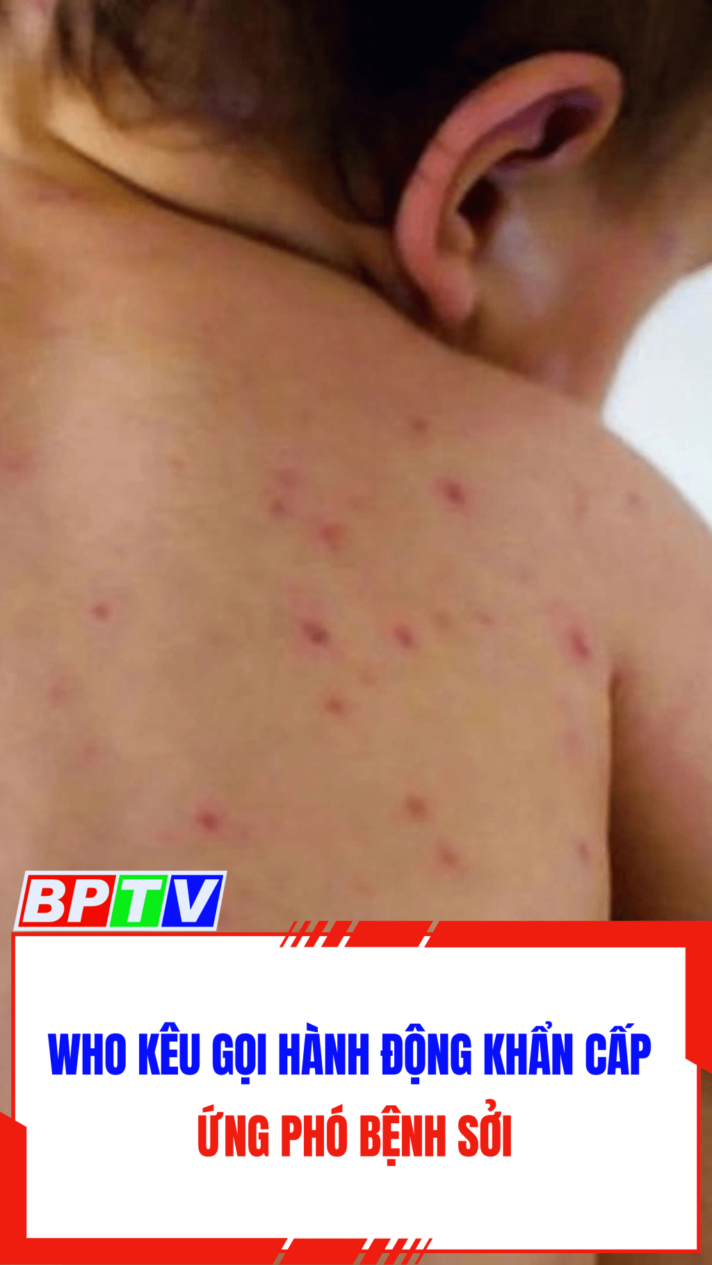 WHO kêu gọi hành động khẩn cấp ứng phó bệnh sởi #shorts